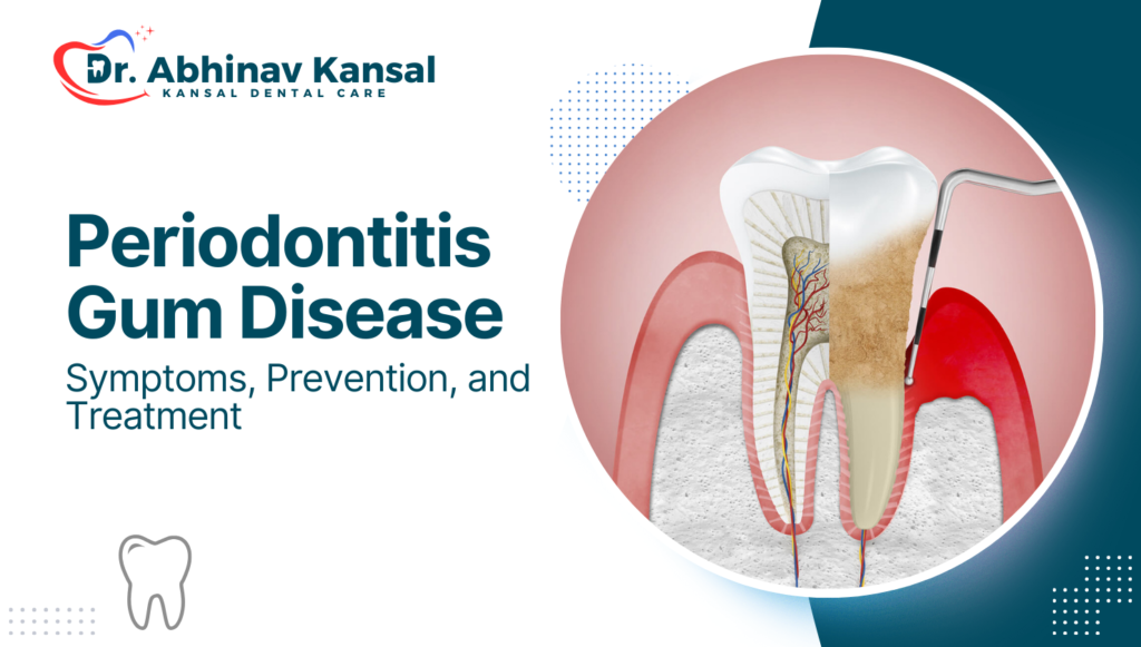 Periodontitis Gum Disease