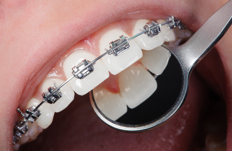 braces soultions in meerut