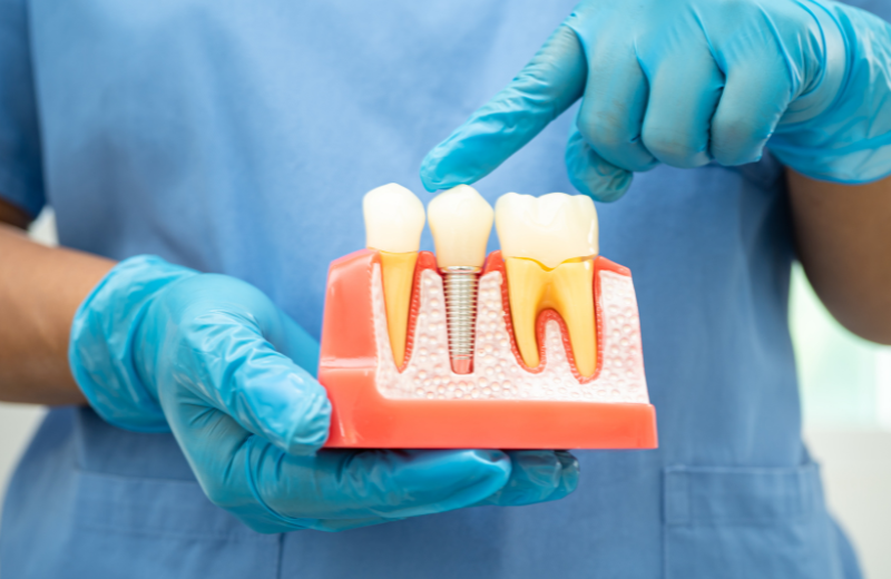 root canal treatment in meerut