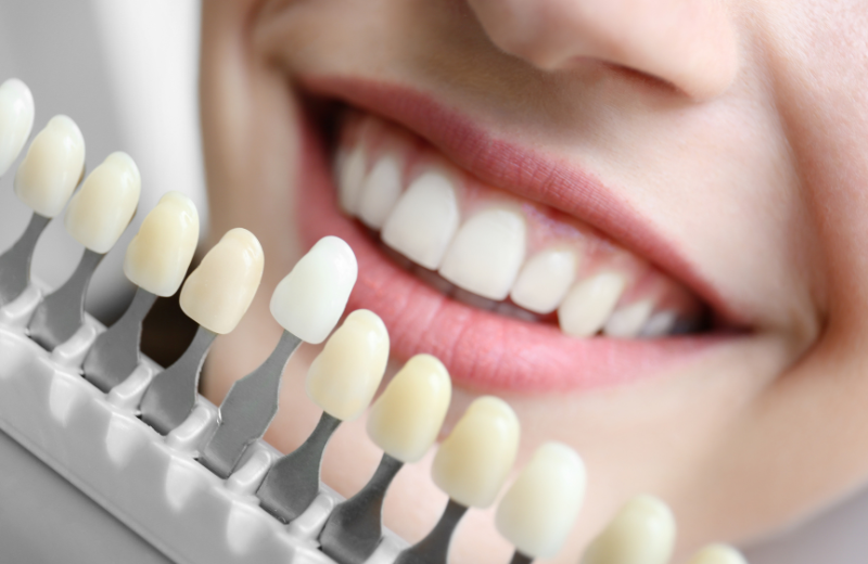 teeth whitening in meerut