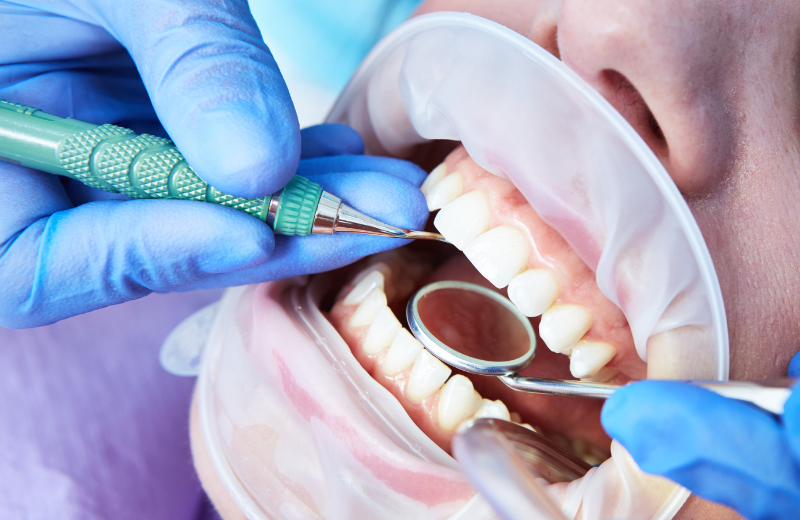 Cavity Treatment