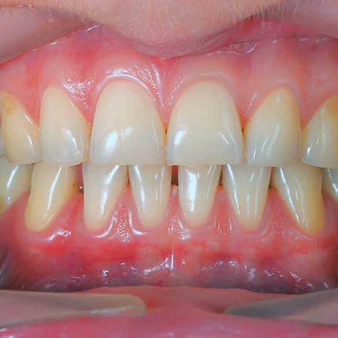 gums closeup disease