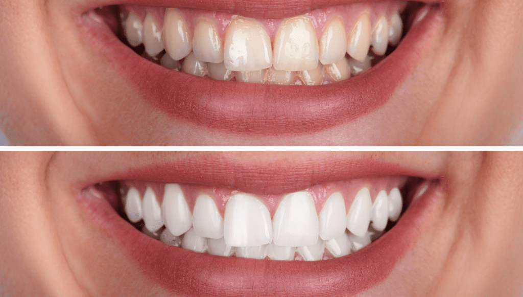 teeth whitening