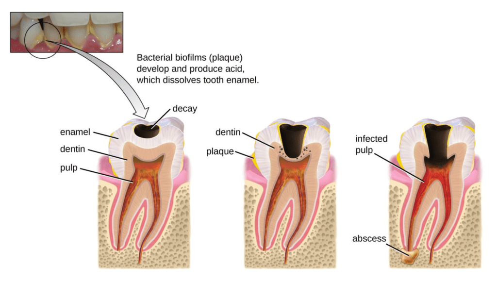 tooth cavity