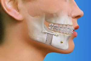 a face showing illustration of jaw fracture(broken)